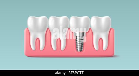 3D tooth implant installation background. Vector realistic illustration of dental prosthesis, bridge with screw fixture and crown restoration, modern dentistry technology, oral care, treatment design Stock Vector