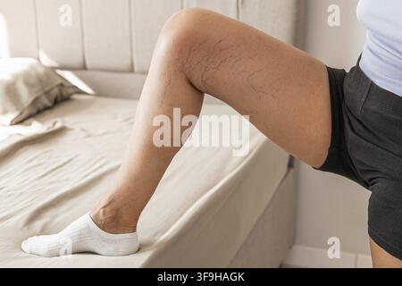 A close-up of a leg showing visible varicose veins and capillaries. The person is wearing black shorts and white socks, with a bed in the background Stock Photo