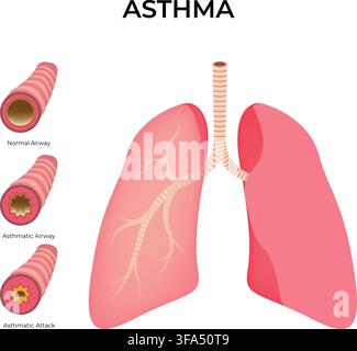 Asthma Lung Anatomy Showing Normal Airway Asthmatic Airway and Asthma Attack Stock Vector