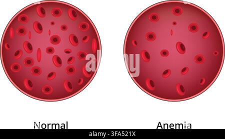 Normal Blood and Anemia Comparison Showing Red Blood Cell Count Medical Illustration Stock Vector