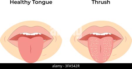 Healthy Tongue and Oral Thrush Infection Comparison Medical Illustration Stock Vector