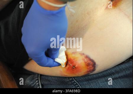 Removal of sutures in a patient after a laparoscopy for a bowel problem. Disinfection with Betadine. Home-visiting private nurse Bsip 016985 097 Stock Photo