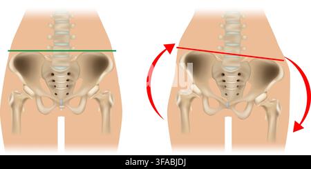 Pelvic Obliquity and Hip Imbalance Medical Anatomy Illustration. Normal and Tilted Pelvis Comparison Showing Pelvic Misalignment. Pelvic Tilt and Stock Vector