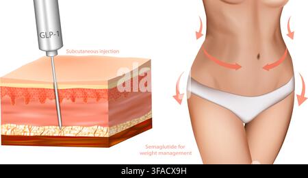 Medical illustration showing semaglutide GLP-1 therapy for weight management and obesity treatment. Subcutaneous injection into adipose tissue with Stock Vector