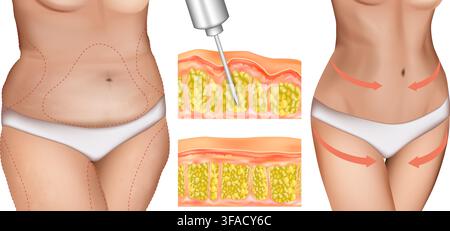 Medical illustration of semaglutide GLP-1 injection for obesity treatment and weight management. Female body before and after weight loss with Stock Vector