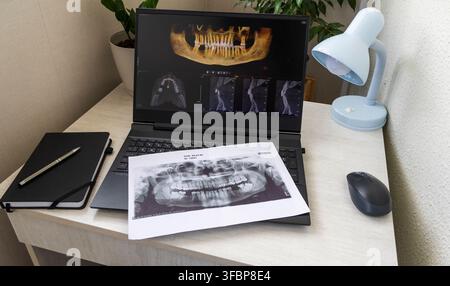 Laptop Displaying Dental 3D CBCT Tomography Software with Printed Jaw Panoramic X-Ray on Keyboard Stock Photo