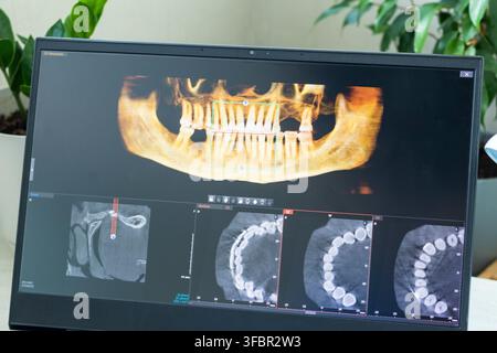 Close-Up of Laptop Screen Displaying 3D Dental CBCT Computed Tomography Diagnostics Software Stock Photo