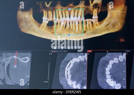 Close-Up of Laptop Screen Displaying 3D Dental CBCT Computed Tomography Diagnostics Software Stock Photo