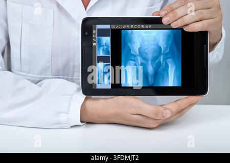 Medical professional holding a digital tablet showing a pediatric pelvic X-ray radiography for evaluating hip joint formation and detecting congenital Stock Photo