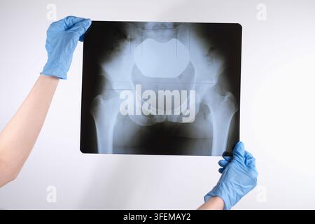 Gloved hands holding pelvic radiograph on white background, showing hip joint anatomy and medical imaging review for diagnosis, orthopedics, patient Stock Photo