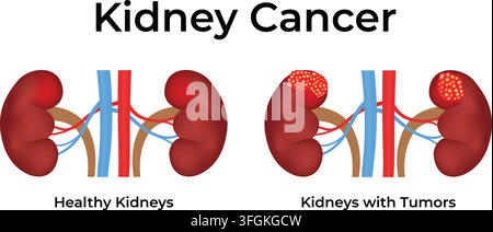 Kidney Cancer Showing Comparison Between Healthy Kidneys and Kidneys with Tumors Stock Vector