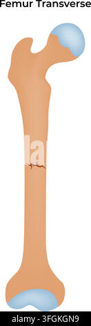 Femur Oblique Nondisplaced Fracture Showing Hairline Break in the Thigh Bone Stock Vector