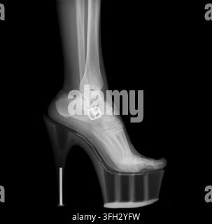 x-ray revealing the skeletal structure of a human foot. Including a surgical implant. Positioned precariously in a platform high heel shoe against a s Stock Photo
