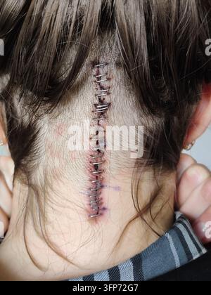 A close-up view of a healing surgical incision on the back of the neck and head secured with metal staples following duraplastic surgery for Arnold-Ch Stock Photo