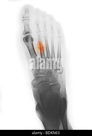 X-ray of the foot showing a healing fracture 2nd metatarsal Stock Photo ...