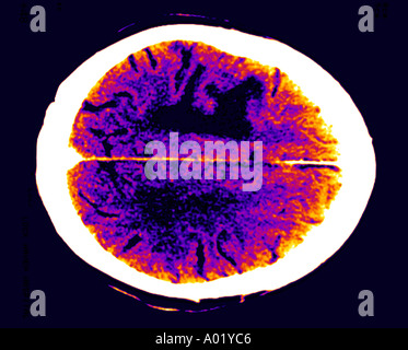 CAT scan showing brain edema from a tumor Stock Photo