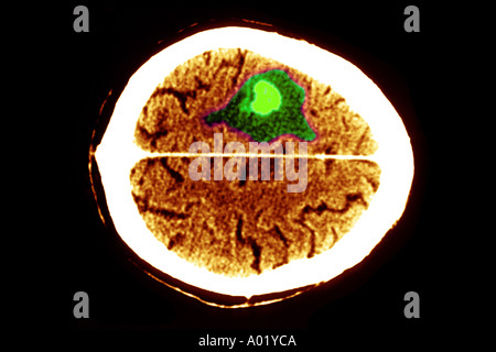 CAT scan showing brain tumor and edema Stock Photo