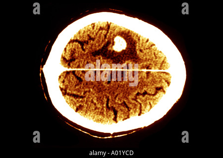 CAT scan showing brain edema from a tumor Stock Photo