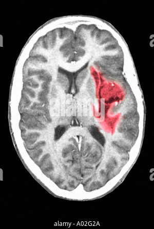 CAT scan showing glioma brain tumor Stock Photo: 3217447 ...