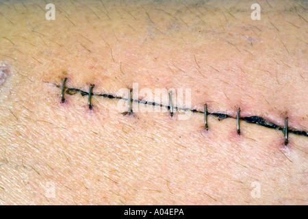 Stainless Steel Metal staples closing a surgical wound Stock Photo