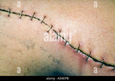 Stainless Steel Metal staples closing a surgical wound Stock Photo