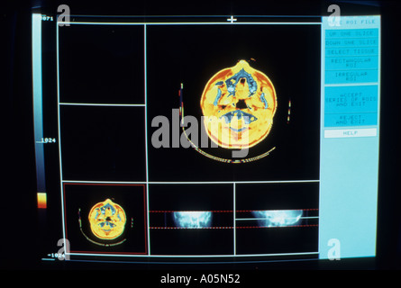 Close up of a computer monitor displaying the results of a CAT scan Stock Photo