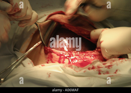 Close up of a caesarian section in theatre during a birth. Stock Photo