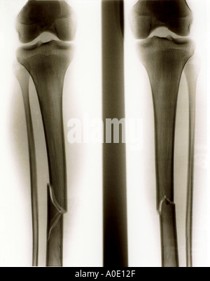 Fractured Tibia Stock Photo