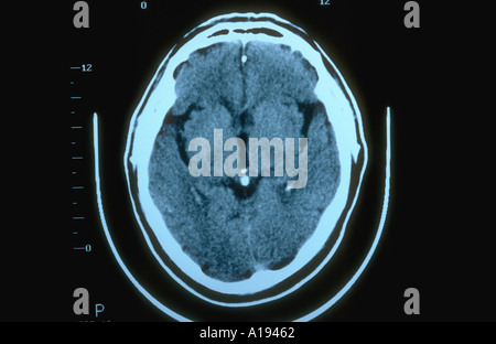 CT scan showing a cross section of a human head Stock Photo - Alamy
