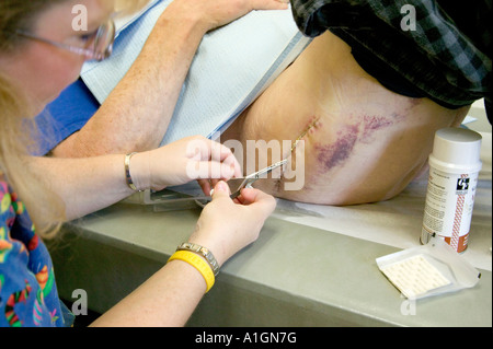 nurse, hip, staplesNurse removing stainless steel surgical staples from  total right hip arthroplasty. Stock Photo