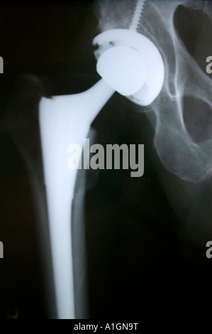 X-ray total right hip arthroplasty replacement Stock Photo