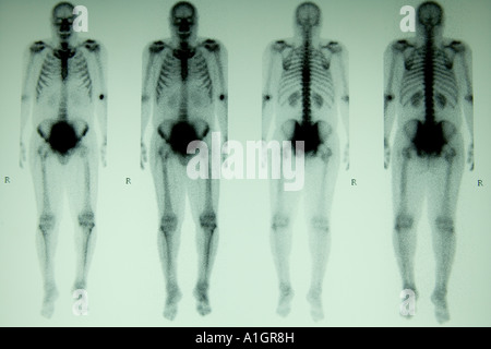 Nuclear bone scan, full body three phase, Stock Photo