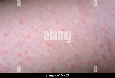 PAPULAR RASH Stock Photo: 52487321 - Alamy