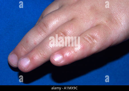 viral exanthem from hand foot and mouth disease Stock Photo