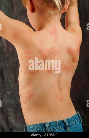 Hives Produced from a Strep Infection Stock Photo