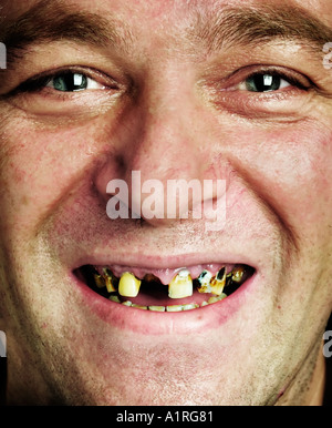 close up of mans face with rotten teeth Stock Photo