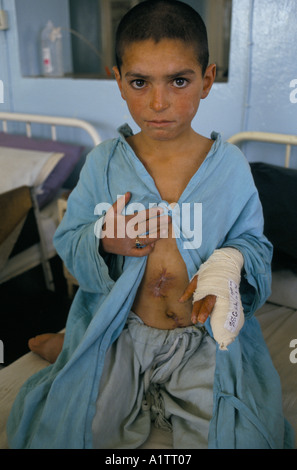 MINES IN AFGHANISTAN. ALLAHNOOR ,MINE VICTIM KABUL 1996 Stock Photo
