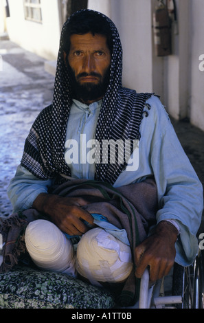 MINES IN AFGHANISTAN . MINE VICTIM HABIBULLAH ICRC (INTERNATIONAL COMMITTEE OF THE RED CROSS ) HOSPITAL KABUL 1996 Stock Photo