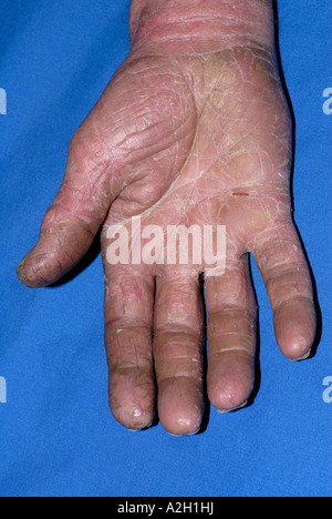 Skin rash of eczema on the palms of a 55 year old man showing severe ...