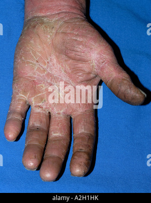 Skin rash of eczema on the palms of a 55 year old man showing severe ...