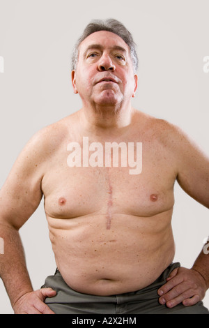 Man shows off his scar from open heart surgery. Bypass cardiac surgery. Stock Photo