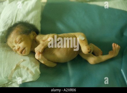 Pham Xuan Lo was born on 10.06.80.  His father, 35, was sprayed with Agent Orange while a soldier in the south. Lo has deformed hands, feet and several internal defects. June 1980 Stock Photo
