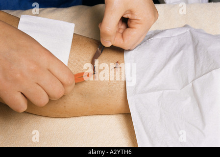 Removing stitches from leg after surgery Stock Photo