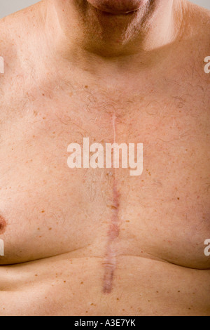 Open heart surgery scar on man's chest. Stock Photo