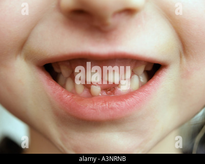 Mouth of little girl 5 five years old with first tooth that has fallen out changing milk teeth closeup shed tooth lost tooth Stock Photo