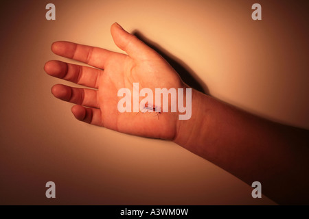 Hand with stitches from carpal tunnel surgery Stock Photo