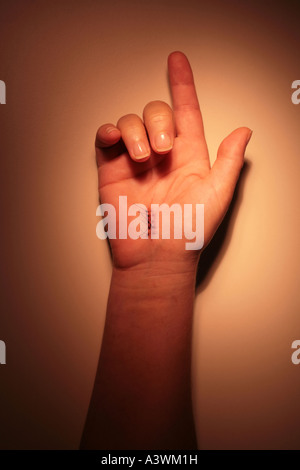 Hand with stitches from carpal tunnel surgery Stock Photo