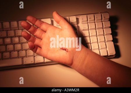 Hand resting on a computer keyboard with stitches in it  from carpal tunnel surgery Stock Photo