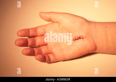 Hand with stitches from carpal tunnel surgery Stock Photo