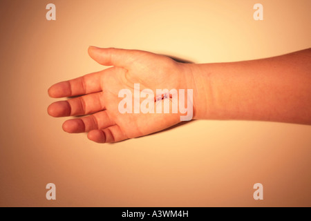 Hand with stitches from carpal tunnel surgery Stock Photo